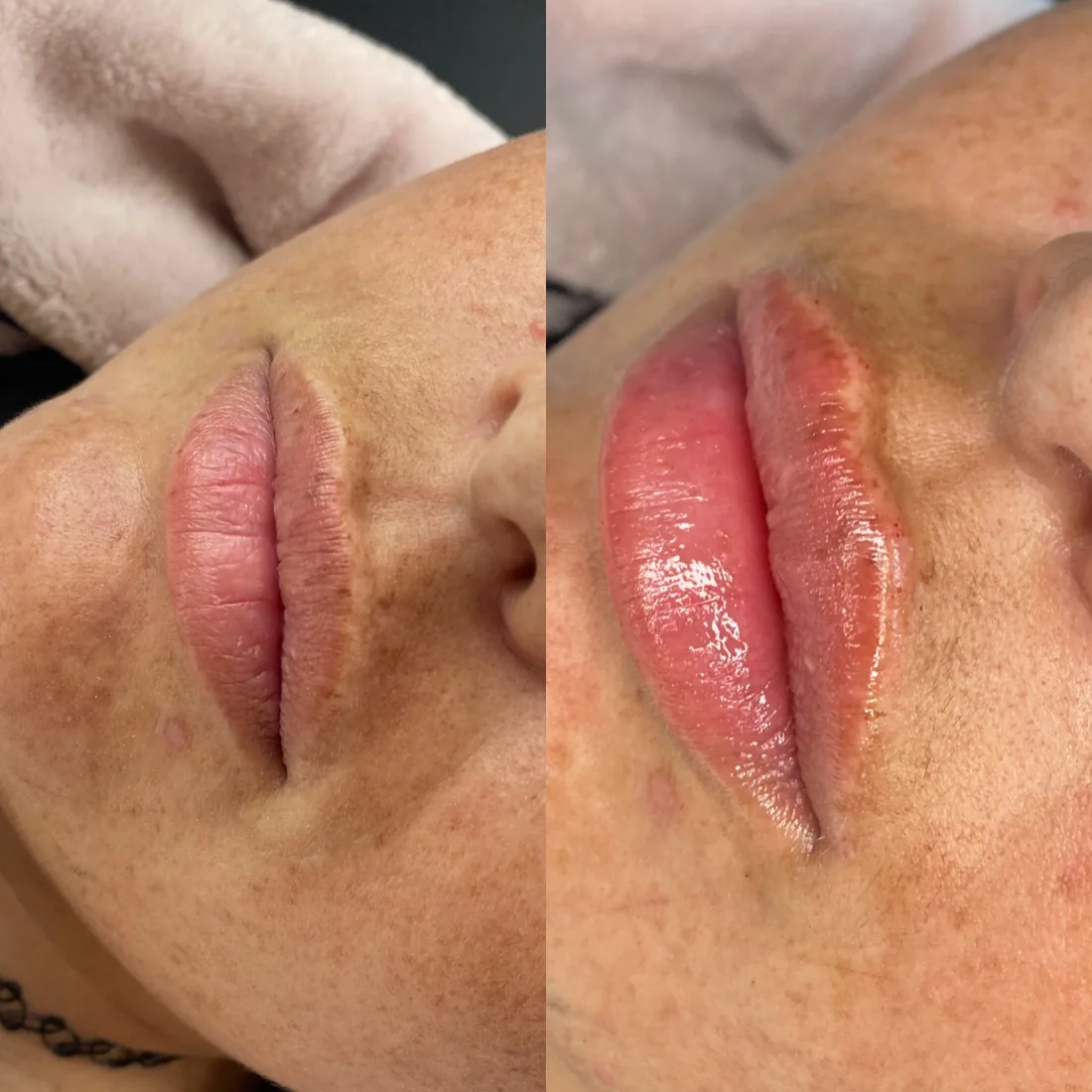 Client comparison photograph 01, published by Refined Medical Aesthetics with permission