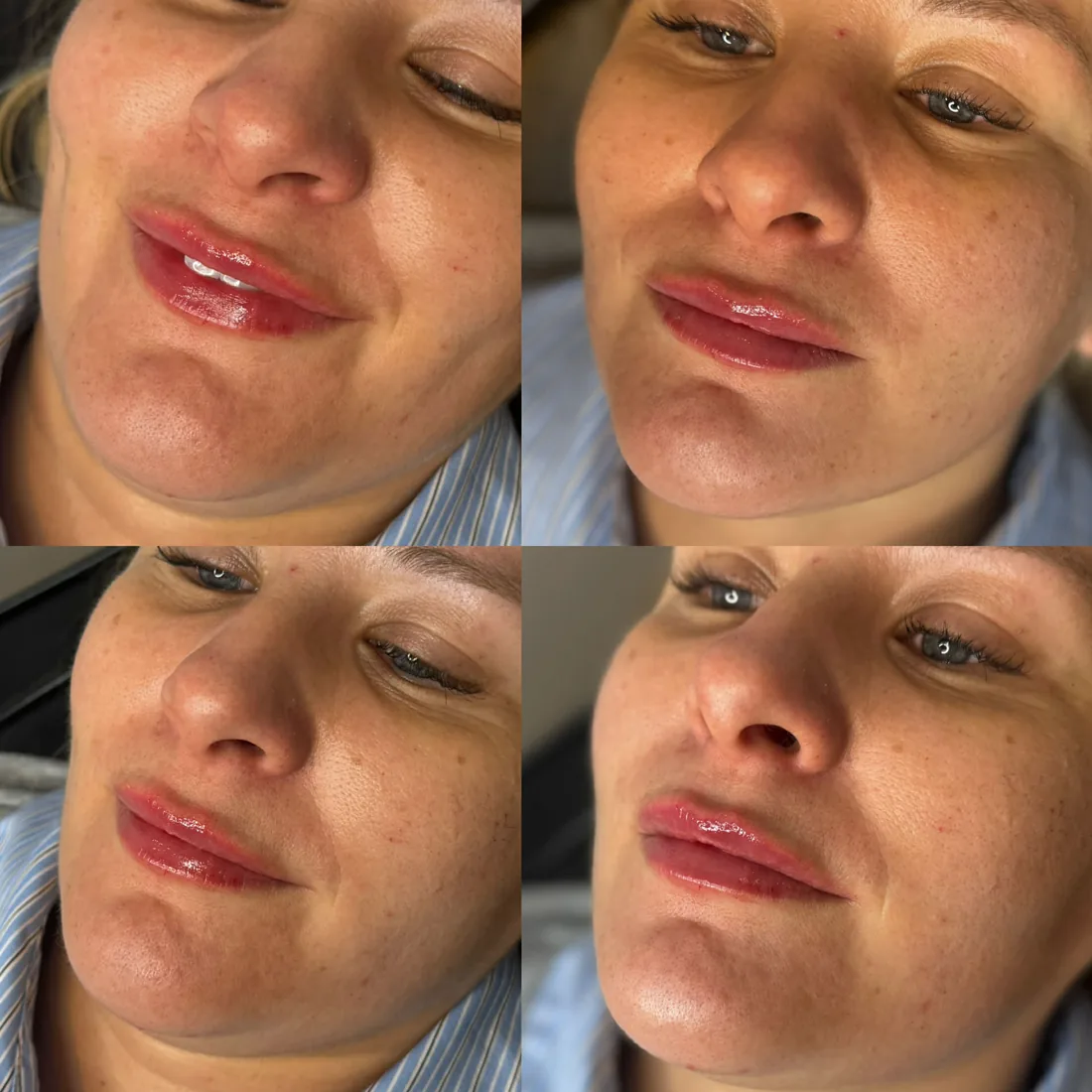 Client comparison photograph 03, published by Refined Medical Aesthetics with permission