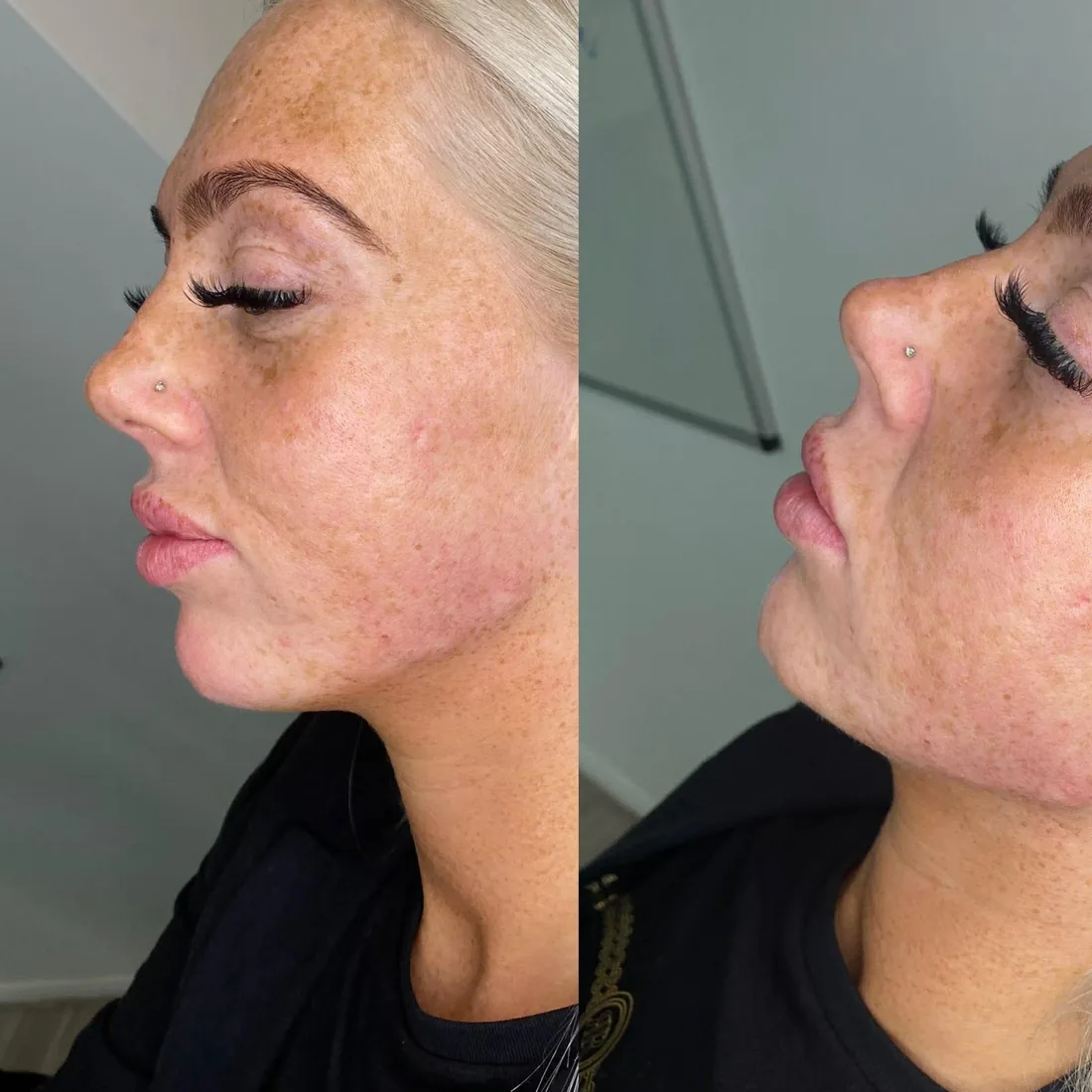 Client comparison photograph 13, published by Refined Medical Aesthetics with permission