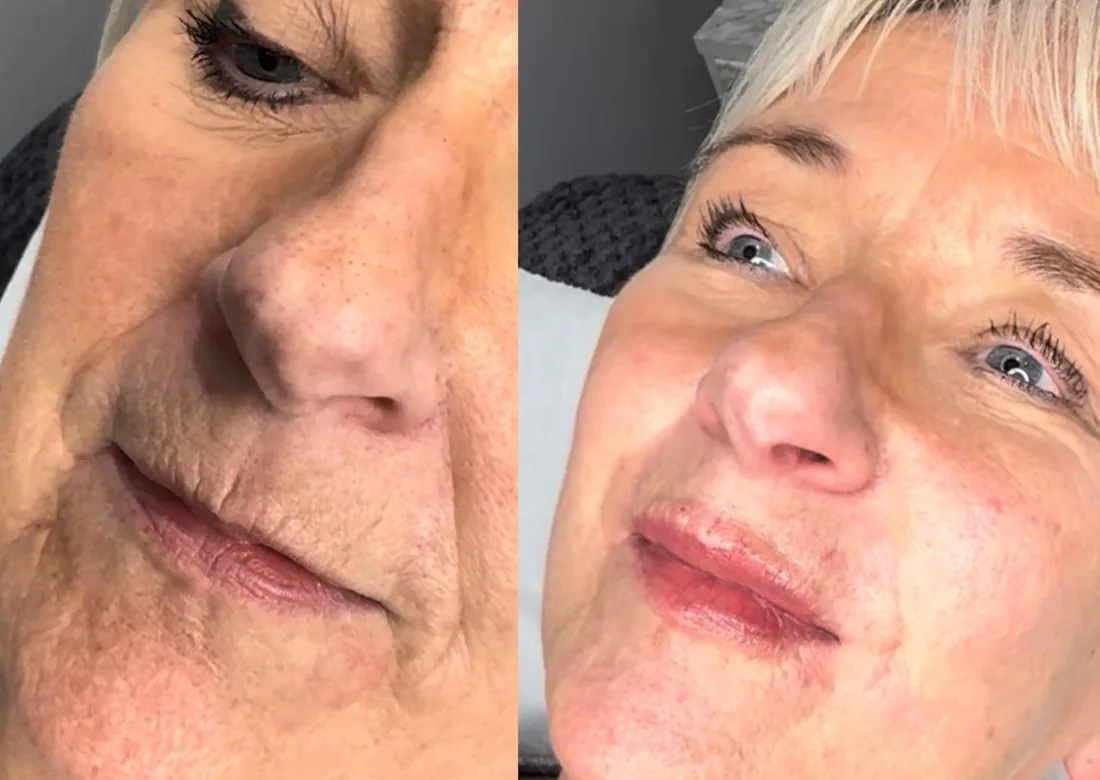 Client comparison photograph 18, published by Refined Medical Aesthetics with permission